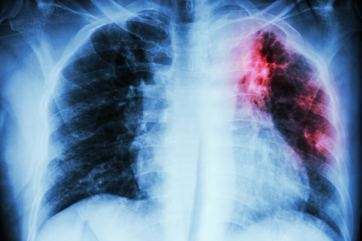 Lee más sobre el artículo Tuberculosis, la pandemia de los pobres