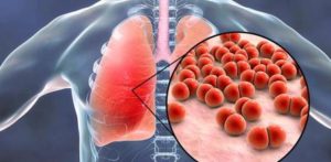 Lee más sobre el artículo La neumonía por Covid-19 causa más mortalidad que la neumonía bacteriémica extrahospitalaria