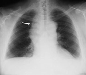 derrame pleural