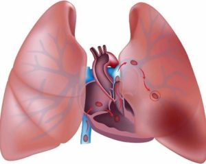 Hipertensión Pulmonar