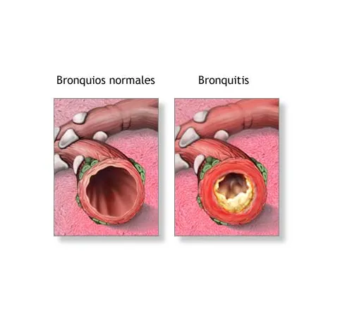 Lee más sobre el artículo Bronquitis Crónica: Causas, Síntomas y Estrategias de Manejo