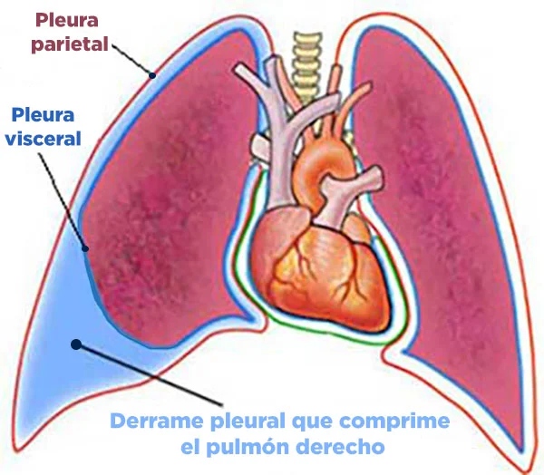 Lee más sobre el artículo Derrame Pleural: Causas, Síntomas y Tratamientos